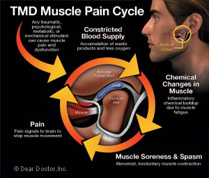 TMD muscle pain cycle diagram.