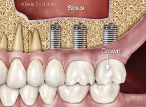 Dental implants are restored with implant crowns.