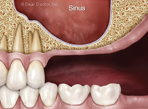 Sinus showing insufficient bone to replace the missing upper posterior teeth.