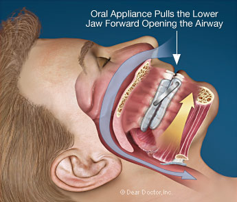 Oral appliances for sleep apnea