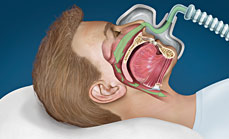CPAP therapy