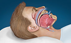 Obstructive sleep apnea