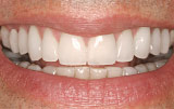 After veneers - Figure 5.