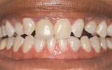 Before veneers - Figure 1.