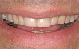 Before veneers - Figure 4.