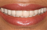 Hollywood white veneers - Figure 2.