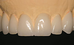 Veneer Tooth Color Chart