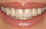 Natural veneers - Figure 9.