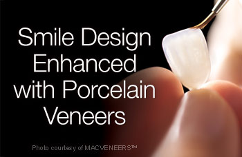 Porcelain veneer.