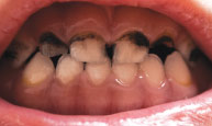 Tooth Decay in child.