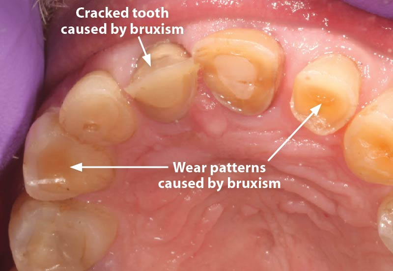 Bruxism causing extreme tooth damage.