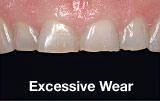 Excessive tooth wear before