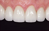 Mild tooth wear after