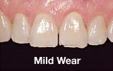 Mild tooth wear before