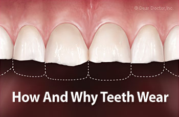 How and why teeth wear