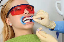 Professional In-Office teeth whitening.