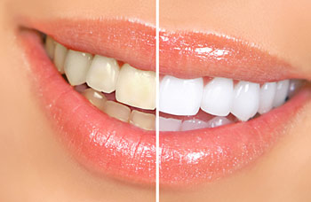 Teeth whitening before and after.