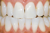 After teeth whitening - Genetics example.