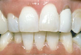 After teeth whitening - Smoking stains example.