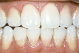 After teeth whitening - Tetracycline example.