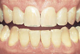 Before teeth whitening - Aging example.