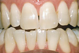 Before teeth whitening - Genetics example.