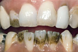 Before teeth whitening - Smoking stains example.