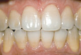 Before teeth whitening - Tetracycline example.