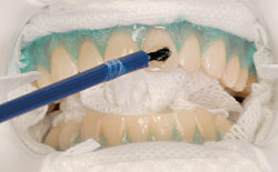 Teeth whitening gel application.