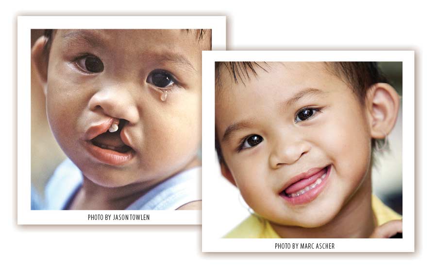 Operation Smile cleft lip before and after.