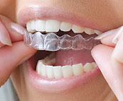 An example of clear orthodontic aligners.