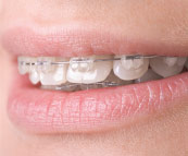 An example of clear orthodontic braces.