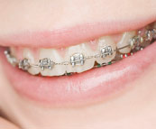 An example of metal braces.