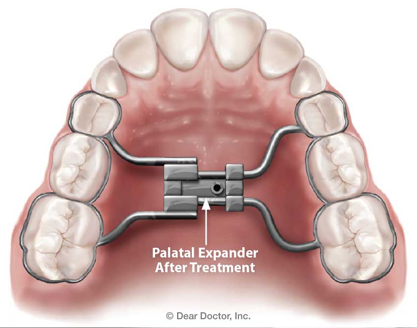 After palatal expander treatment.