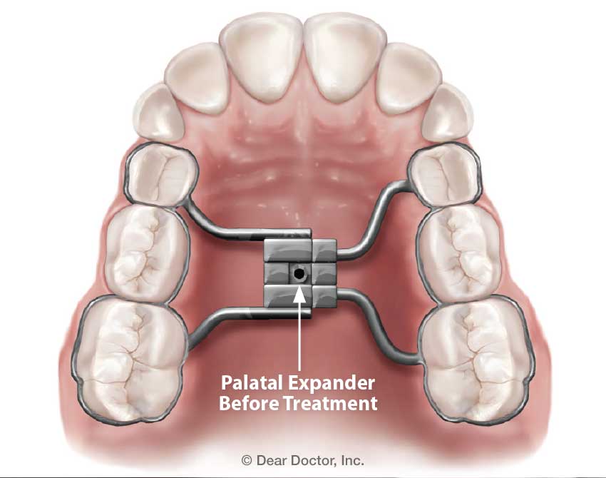 Before palatal expander treatment.