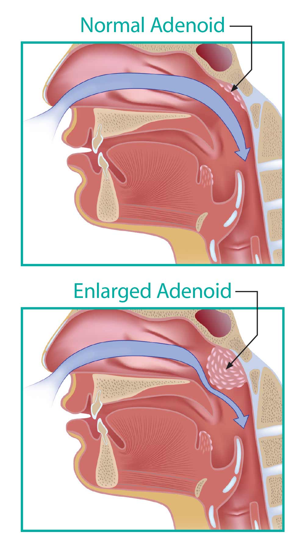 Normal vs enlarged adenoid.