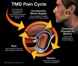 TMD pain cycle diagram.