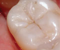 Direct composite restoration.