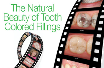 Tooth colored fillings in dentistry.