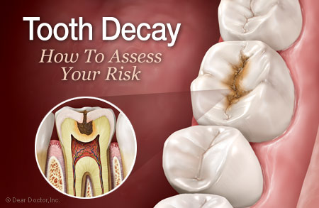 Tooth decay risk.