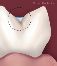 Sealant protecting the groove of a tooth.