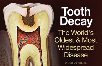 Tooth decay.