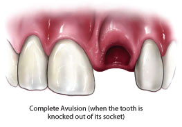 Avulsed tooth.