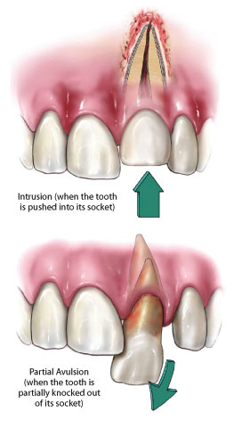 Dislodged teeth.