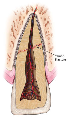 Root fracture.