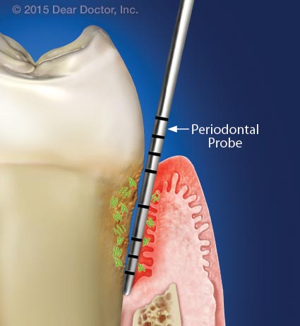 Diseased periodontal pocket.