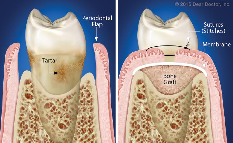 Traditional periodontal therapy illustration.