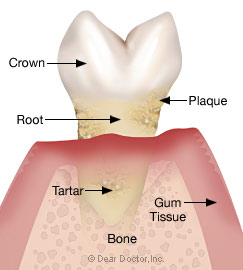 Stage 4 - Advanced periodontitis.