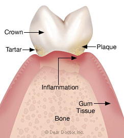 Stage 2 - Early periodontitis.