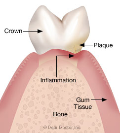 Stage 1 - Gingivitis.